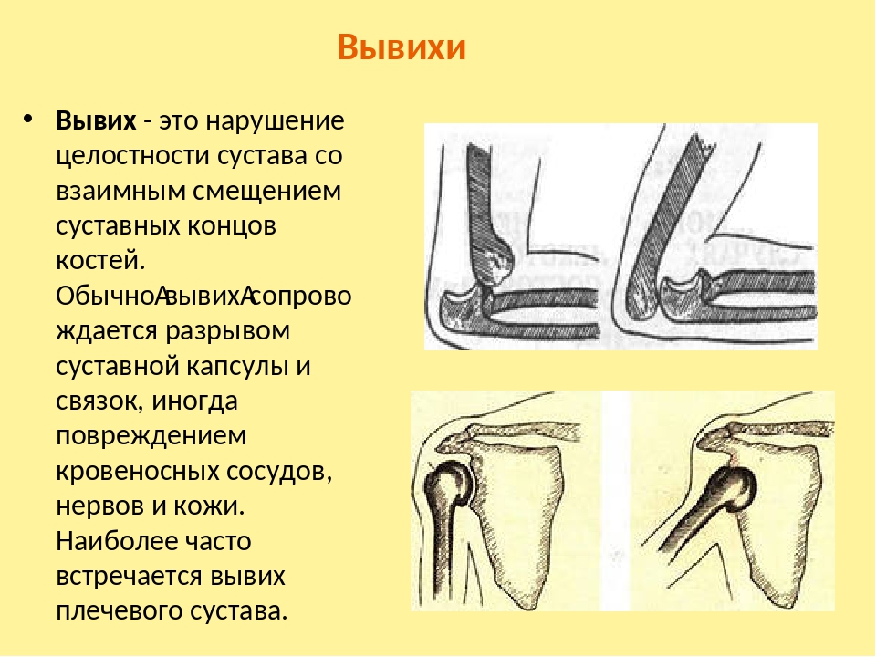 Вывих коленного сустава карта вызова